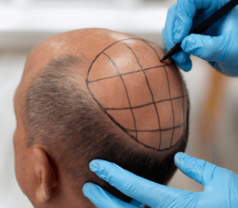 Ankara Fue Tekniği Saç Ekimi